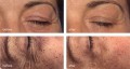 Mesoestetic Global Eyecon Set